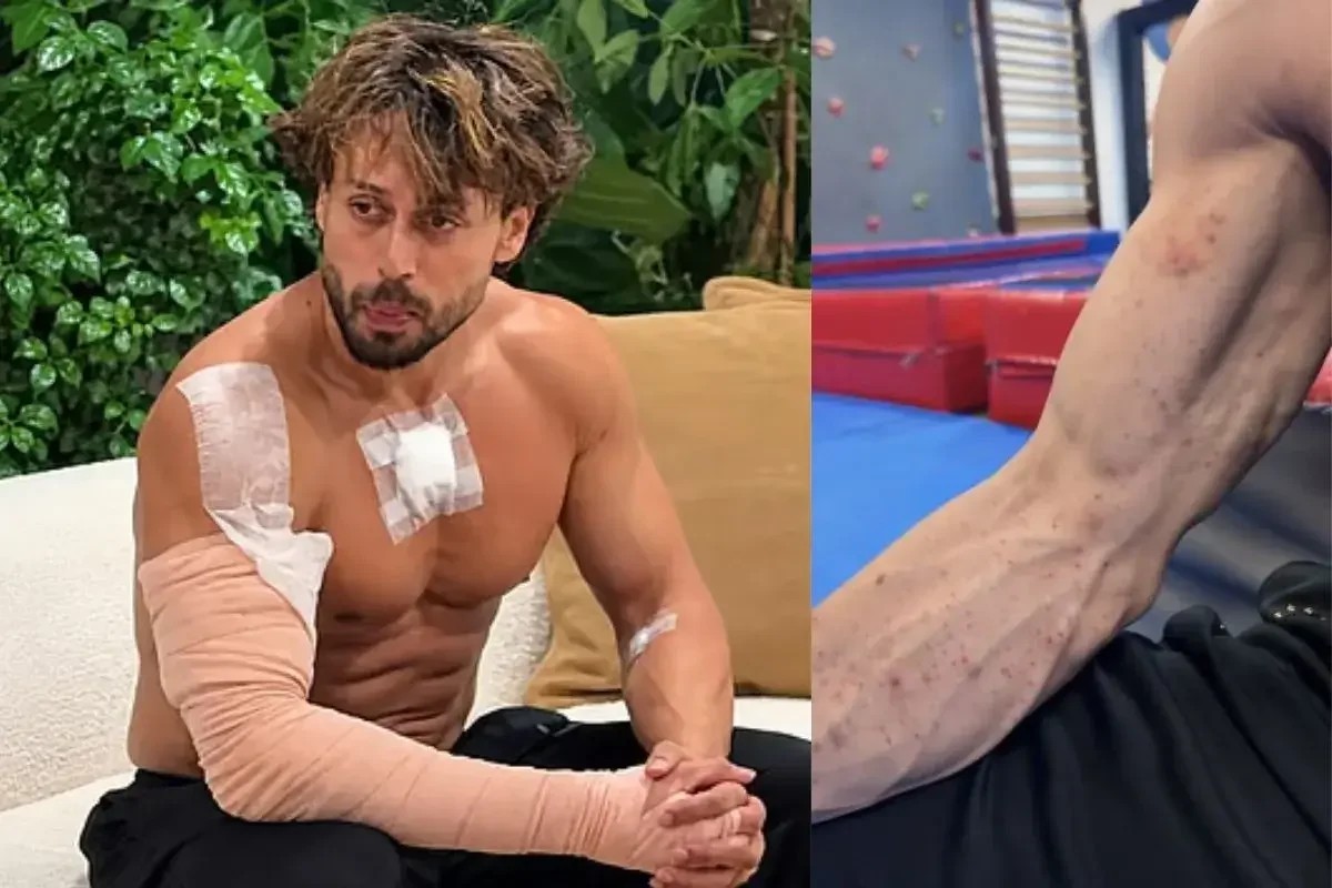 Tiger Shroff gunpowder burn marks: actor with bandages and close-up of burn marks on his arm